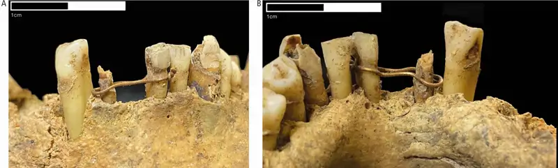 Hallan un puente dental de oro de hace 500 años: así se “arreglaban ...