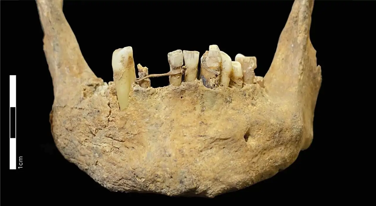 Hallan un puente dental de oro de hace 500 años: así se “arreglaban ...